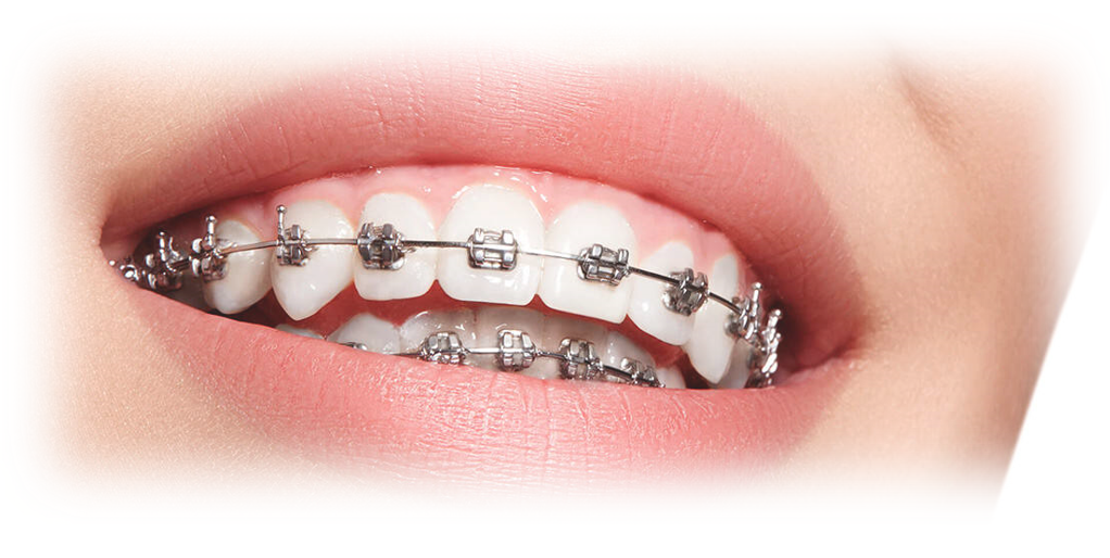 Brackets Ortodoncia